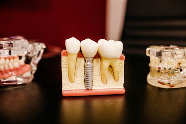 Aparelho fixo metálico — modelo odontológico com bráquetes