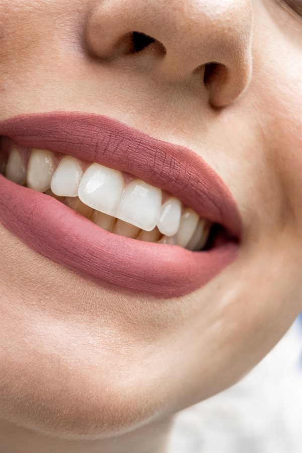Aparelho estético — sorriso alinhado e discreto