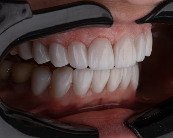 Clareamento dental — dentes alinhados e mais brancos